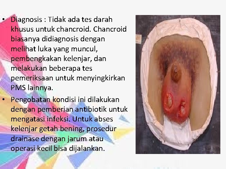  • Diagnosis : Tidak ada tes darah khusus untuk chancroid. Chancroid biasanya didiagnosis