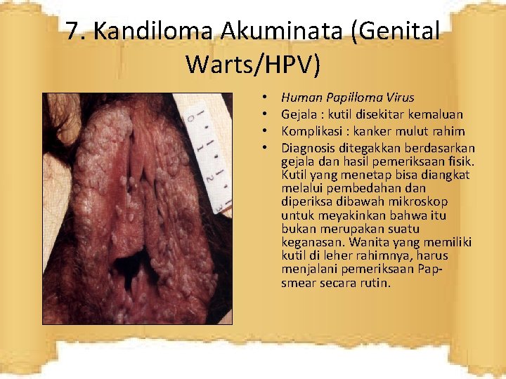 7. Kandiloma Akuminata (Genital Warts/HPV) • • Human Papilloma Virus Gejala : kutil disekitar