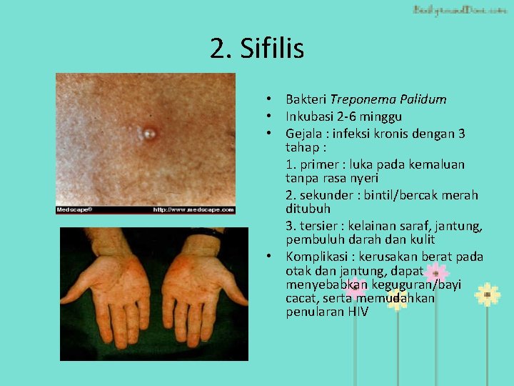 2. Sifilis • Bakteri Treponema Palidum • Inkubasi 2 -6 minggu • Gejala :