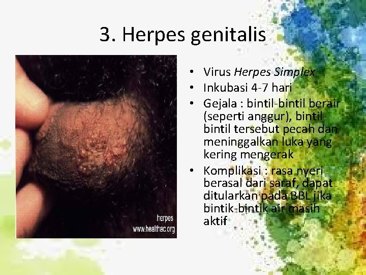 3. Herpes genitalis • Virus Herpes Simplex • Inkubasi 4 -7 hari • Gejala