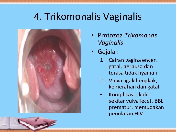 4. Trikomonalis Vaginalis • Protozoa Trikomonas Vaginalis • Gejala : 1. Cairan vagina encer,