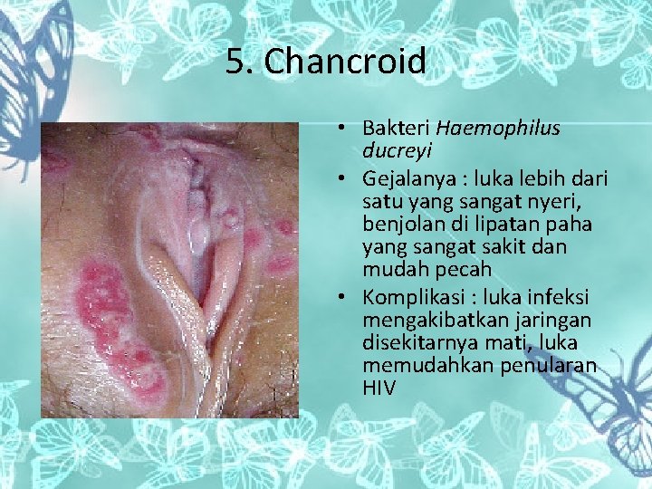 5. Chancroid • Bakteri Haemophilus ducreyi • Gejalanya : luka lebih dari satu yang