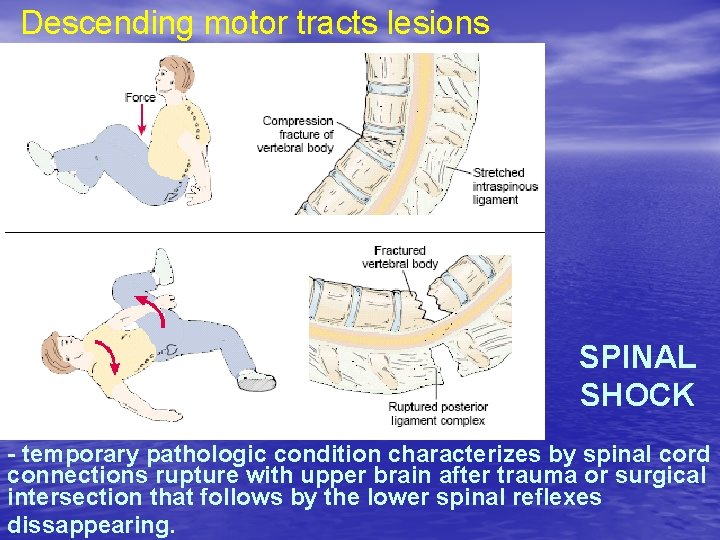 Descending motor tracts lesions SPINAL SHOCK - temporary pathologic condition characterizes by spinal cord