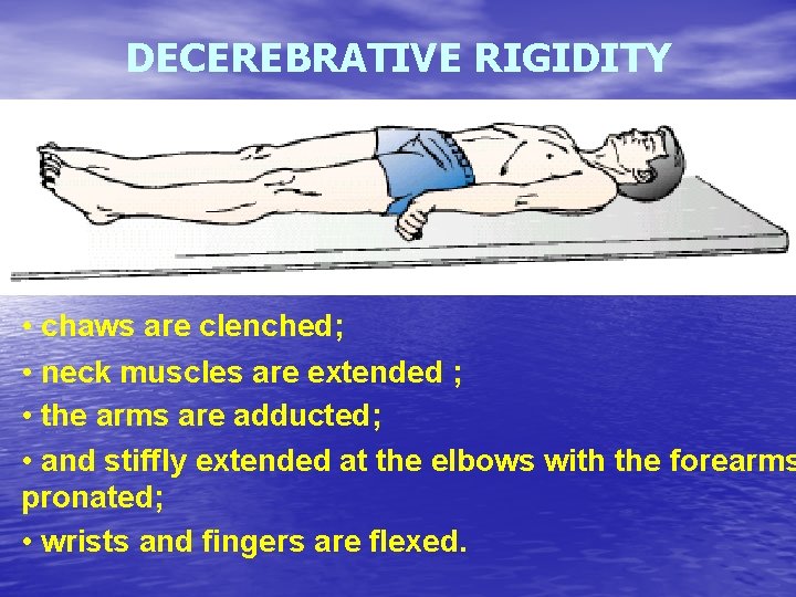 DECEREBRATIVE RIGIDITY • chaws are clenched; • neck muscles are extended ; • the