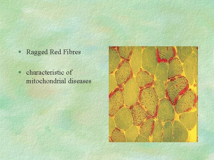 § Ragged Red Fibres § characteristic of mitochondrial diseases 