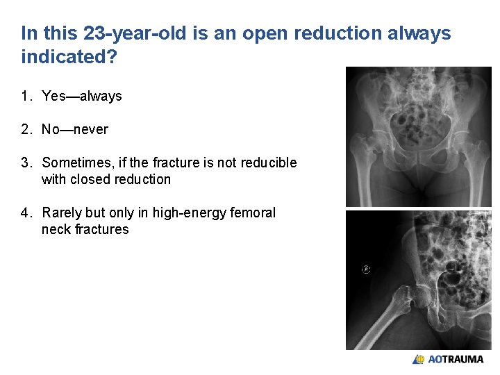 In this 23 -year-old is an open reduction always indicated? 1. Yes—always 2. No—never