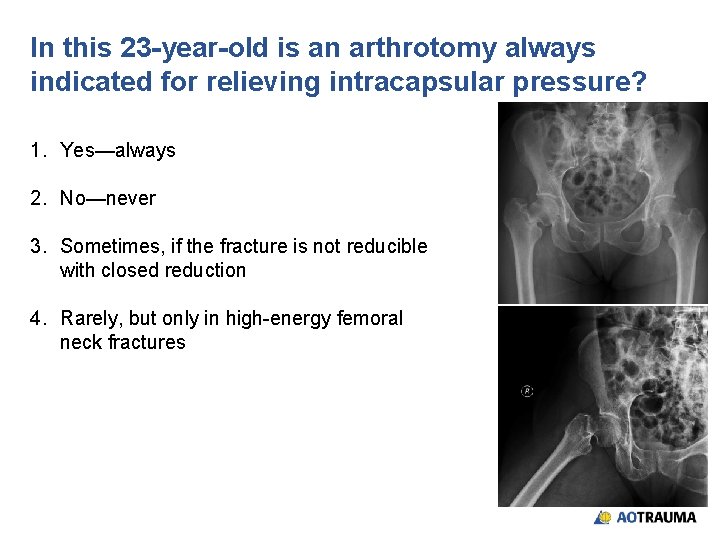 In this 23 -year-old is an arthrotomy always indicated for relieving intracapsular pressure? 1.