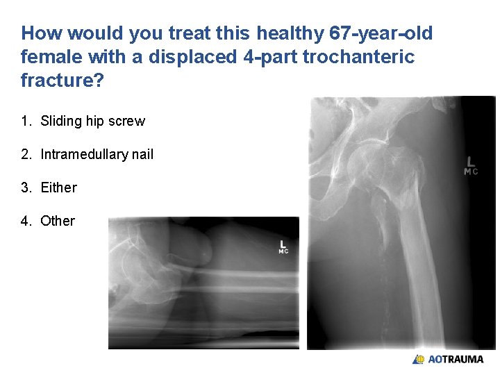 How would you treat this healthy 67 -year-old female with a displaced 4 -part