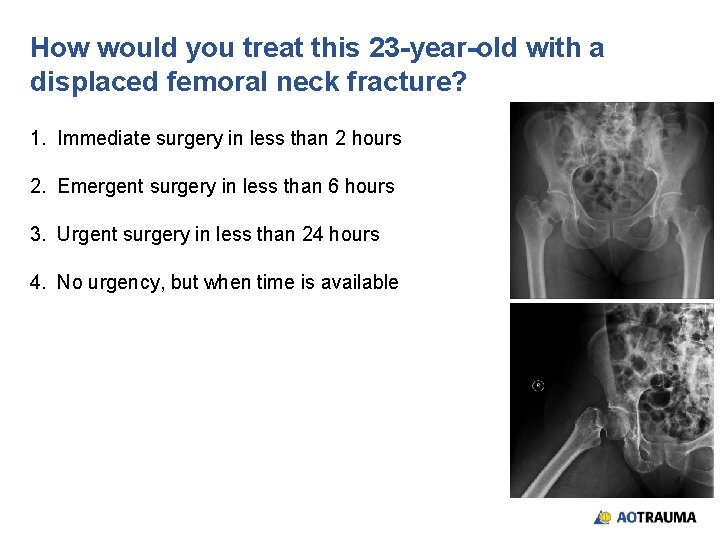 How would you treat this 23 -year-old with a displaced femoral neck fracture? 1.