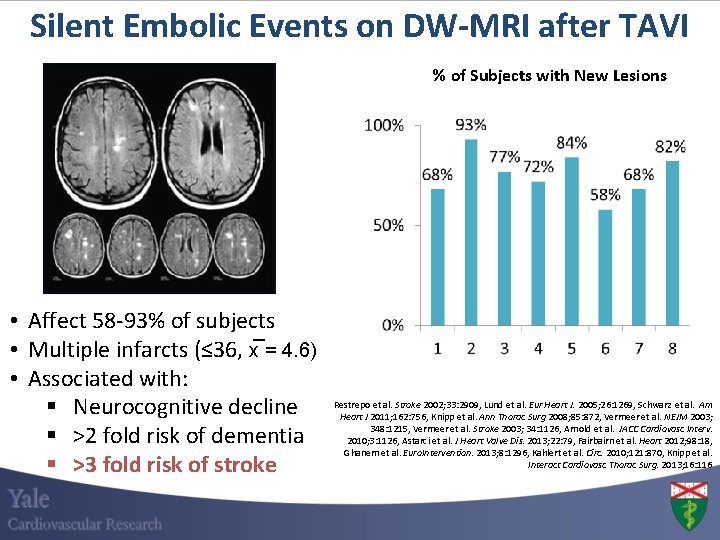 Silent Embolic Events on DW-MRI after TAVI % of Subjects with New Lesions •