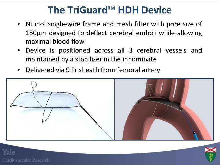 The Tri. Guard™ HDH Device • Nitinol single-wire frame and mesh filter with pore