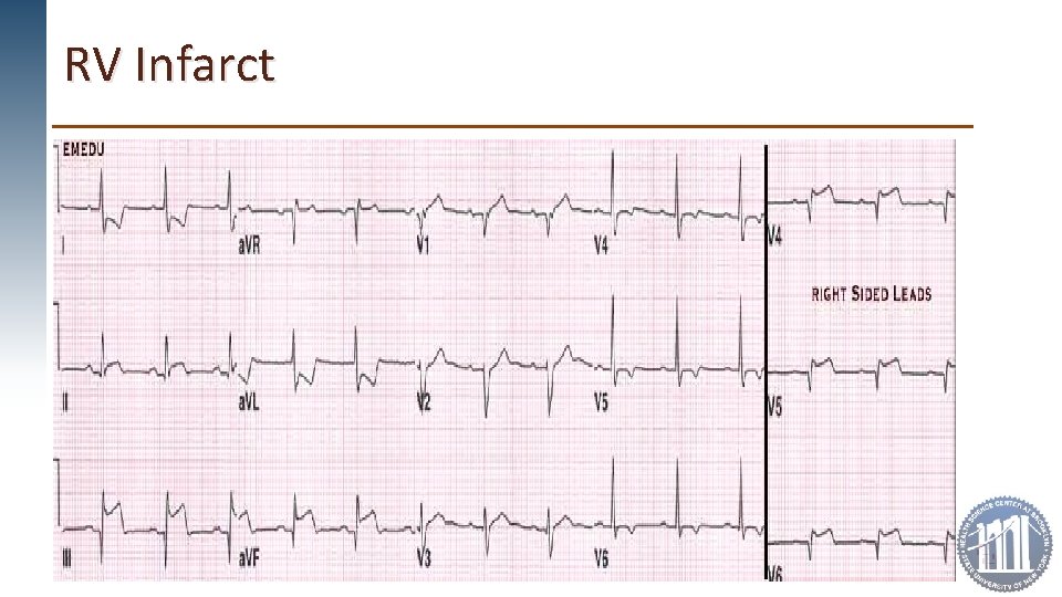RV Infarct 