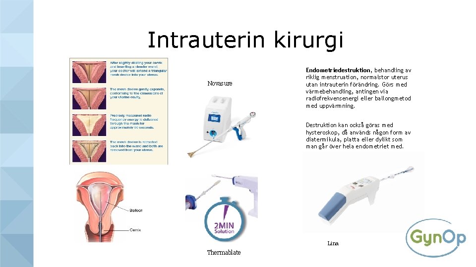 Intrauterin kirurgi Novasure Endometriedestruktion, behandling av riklig menstruation, normalstor uterus utan intrauterin förändring. Görs