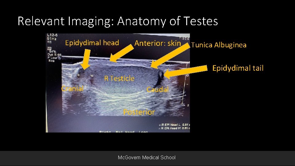 Relevant Imaging: Anatomy of Testes Epidydimal head Anterior: skin Tunica Albuginea Epidydimal tail R