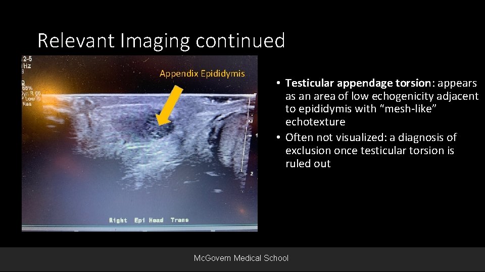 Relevant Imaging continued Appendix Epididymis • Testicular appendage torsion: appears as an area of