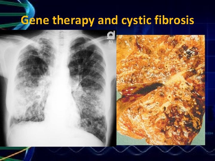 Gene therapy and cystic fibrosis 