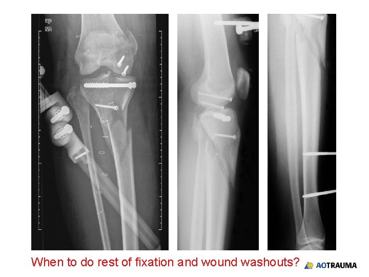 When to do rest of fixation and wound washouts? When to do rest of fixation and wound washouts?