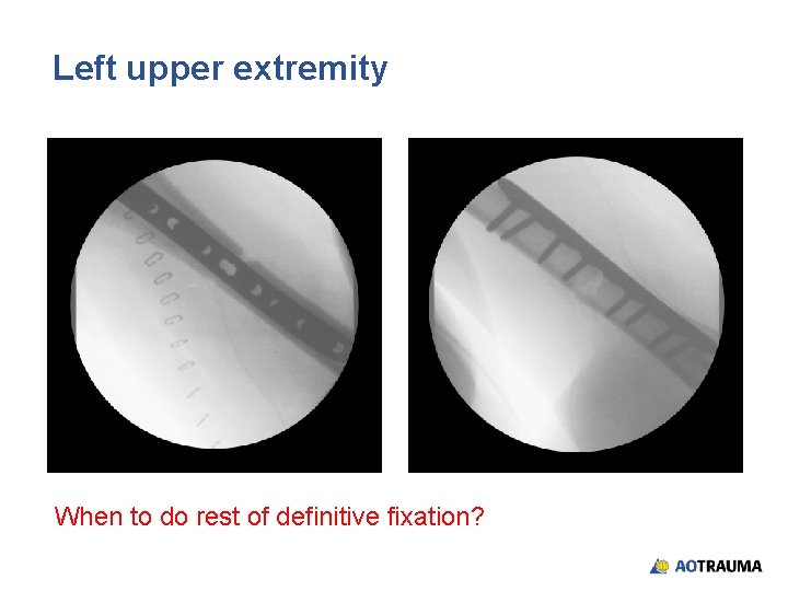 Left upper extremity When to do rest of definitive fixation? Left upper extremity When to do rest of definitive fixation?