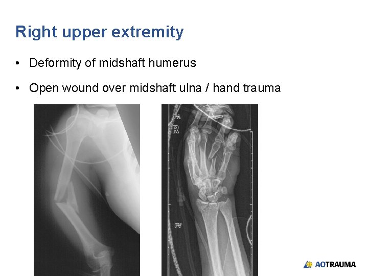 Right upper extremity • Deformity of midshaft humerus • Open wound over midshaft ulna Right upper extremity • Deformity of midshaft humerus • Open wound over midshaft ulna