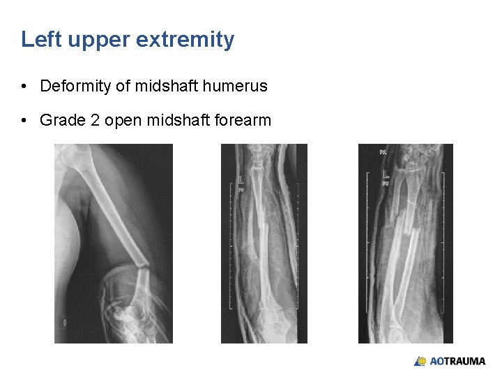 Left upper extremity • Deformity of midshaft humerus • Grade 2 open midshaft forearm Left upper extremity • Deformity of midshaft humerus • Grade 2 open midshaft forearm