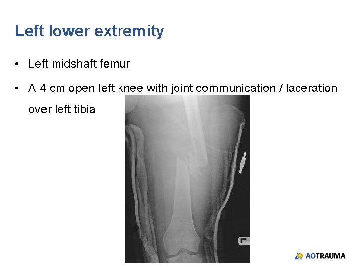 Left lower extremity • Left midshaft femur • A 4 cm open left knee Left lower extremity • Left midshaft femur • A 4 cm open left knee