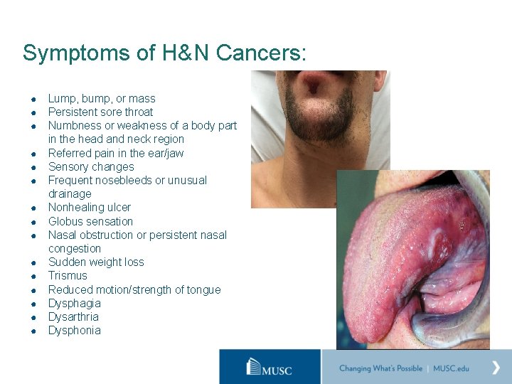 Symptoms of H&N Cancers: ● ● ● ● Lump, bump, or mass Persistent sore