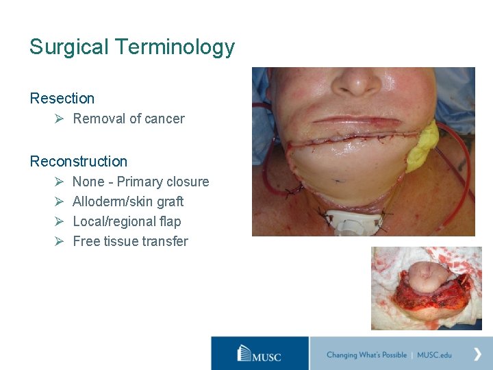 Surgical Terminology Resection Ø Removal of cancer Reconstruction Ø Ø None - Primary closure