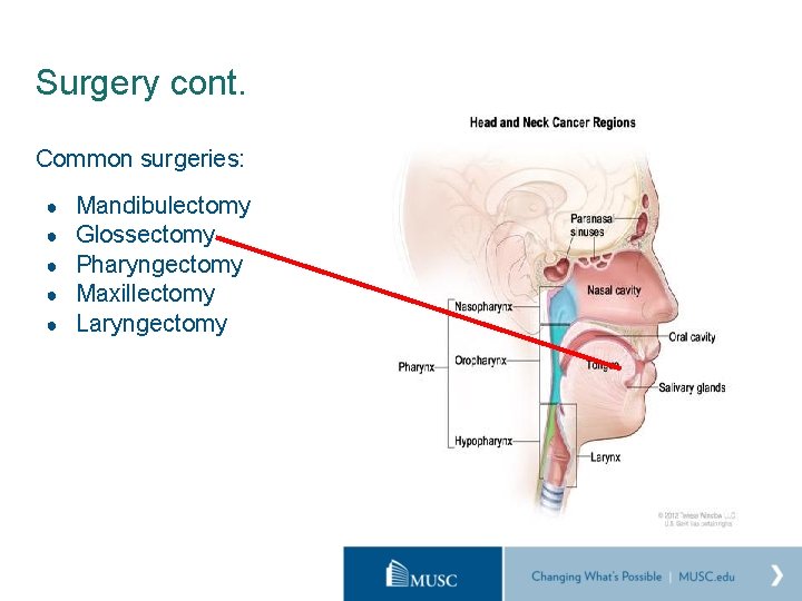 Surgery cont. Common surgeries: ● ● ● Mandibulectomy Glossectomy Pharyngectomy Maxillectomy Laryngectomy 