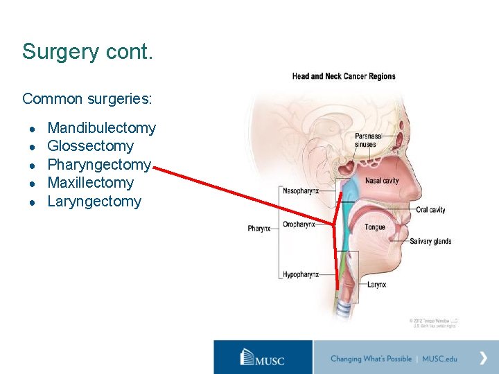 Surgery cont. Common surgeries: ● ● ● Mandibulectomy Glossectomy Pharyngectomy Maxillectomy Laryngectomy 