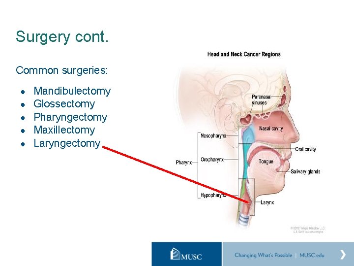 Surgery cont. Common surgeries: ● ● ● Mandibulectomy Glossectomy Pharyngectomy Maxillectomy Laryngectomy 