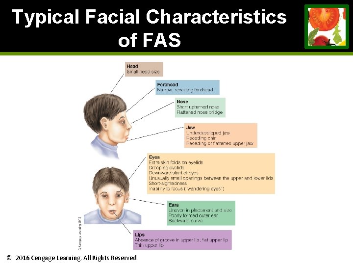 Typical Facial Characteristics of FAS © 2016 Cengage Learning. All Rights Reserved. Typical Facial Characteristics of FAS © 2016 Cengage Learning. All Rights Reserved.