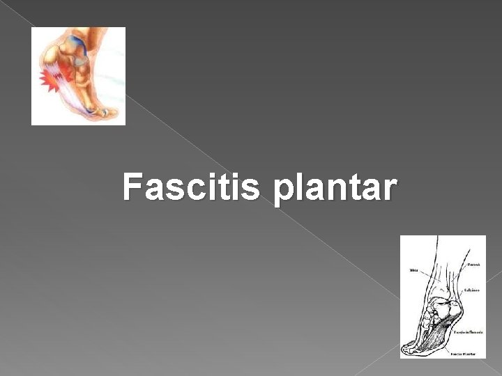 Fascitis plantar 