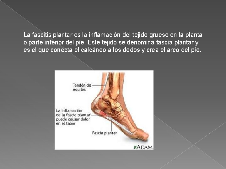 La fascitis plantar es la inflamación del tejido grueso en la planta o parte