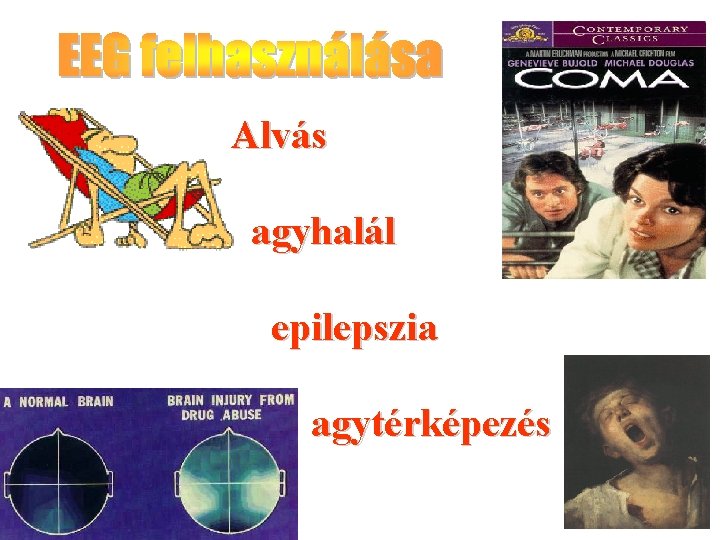 Alvás agyhalál epilepszia agytérképezés 