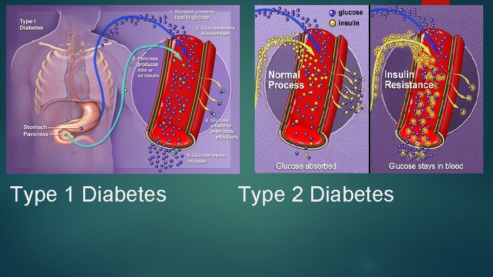 Type 1 Diabetes Type 2 Diabetes 