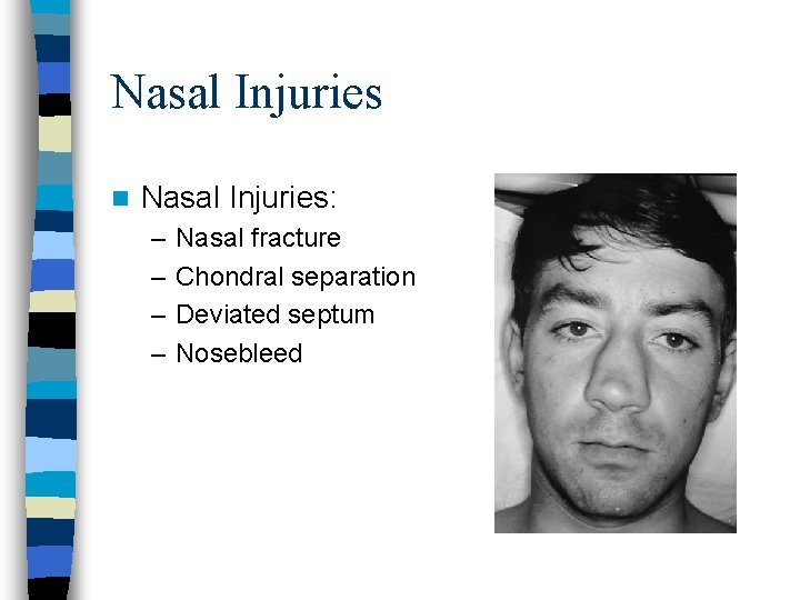 Nasal Injuries n Nasal Injuries: – – Nasal fracture Chondral separation Deviated septum Nosebleed