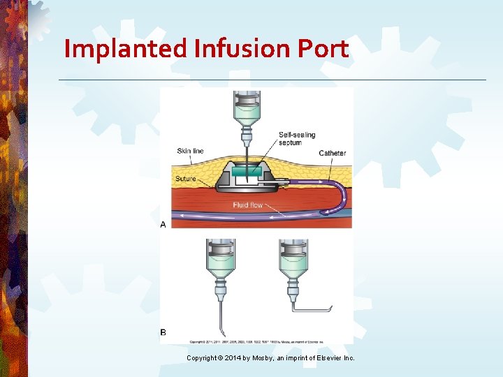 Implanted Infusion Port Copyright © 2014 by Mosby, an imprint of Elsevier Inc. Implanted Infusion Port Copyright © 2014 by Mosby, an imprint of Elsevier Inc.