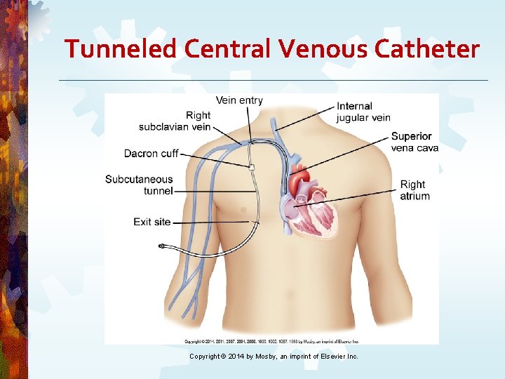 Tunneled Central Venous Catheter Copyright © 2014 by Mosby, an imprint of Elsevier Inc. Tunneled Central Venous Catheter Copyright © 2014 by Mosby, an imprint of Elsevier Inc.