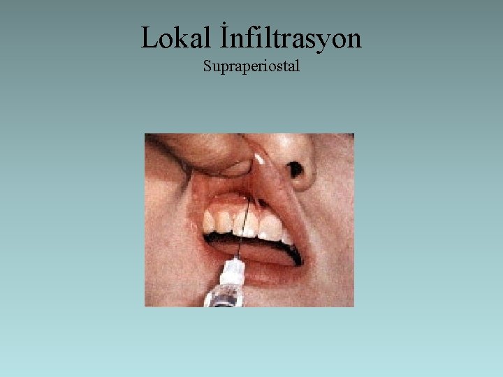 Lokal İnfiltrasyon Supraperiostal 