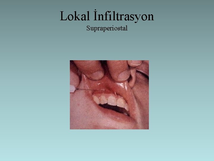 Lokal İnfiltrasyon Supraperiostal 