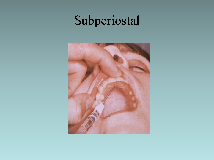 Subperiostal 