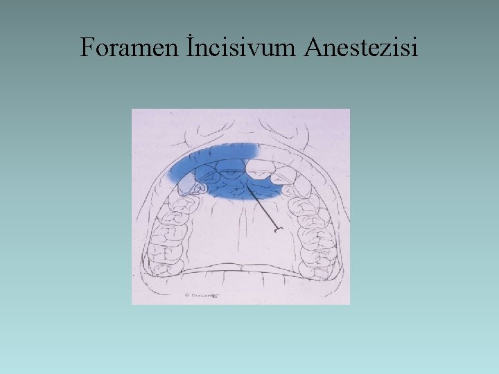 Foramen İncisivum Anestezisi 