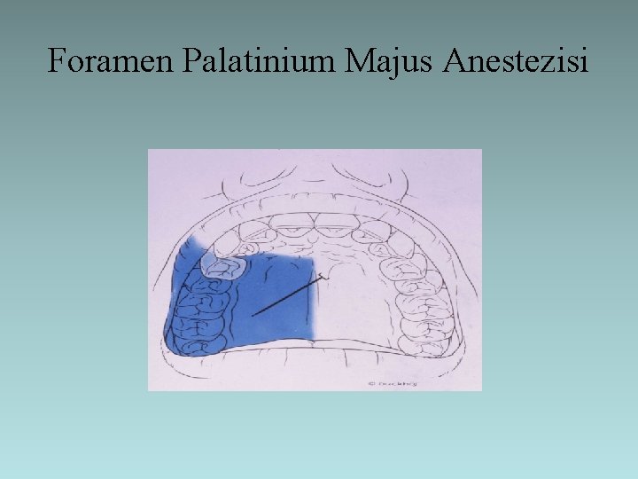 Foramen Palatinium Majus Anestezisi 