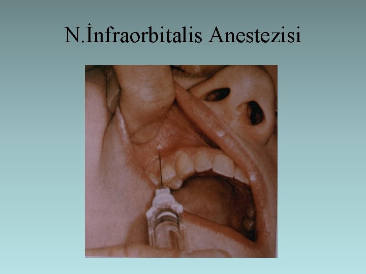 N. İnfraorbitalis Anestezisi 