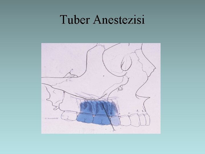 Tuber Anestezisi 
