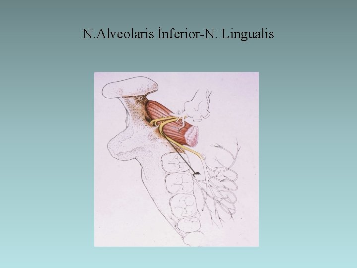 N. Alveolaris İnferior-N. Lingualis 