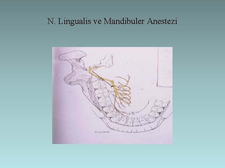 N. Lingualis ve Mandibuler Anestezi 