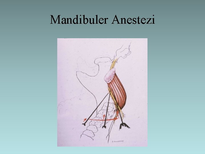 Mandibuler Anestezi 