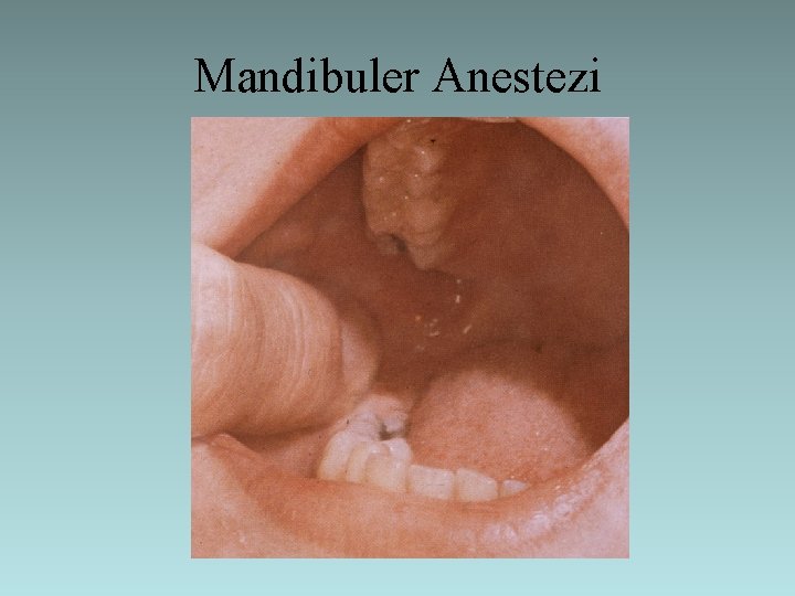 Mandibuler Anestezi 