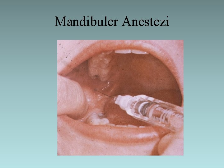 Mandibuler Anestezi 